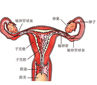 输卵管不孕