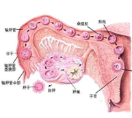 多囊卵巢综合症