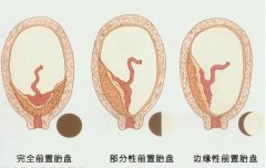 <b>西安孕期检查：前置胎盘是什么？</b>